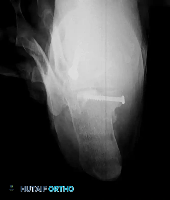 Internal Fixation of Sustentaculum Fracture