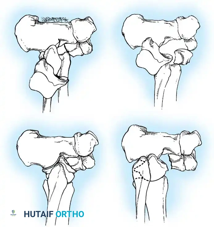 Hawkins Classification Diagram