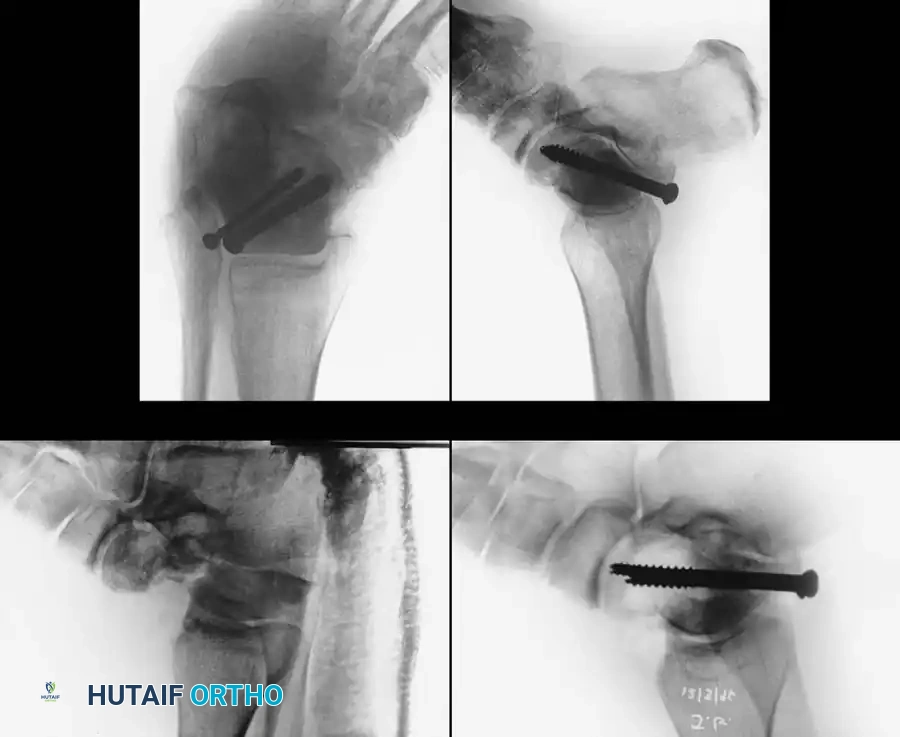 Displaced talar neck diagram