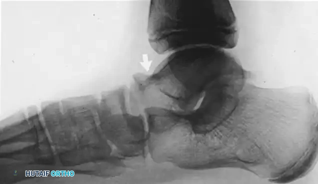 Talocalcaneal Coalition: Comprehensive Diagnosis and Surgical Management