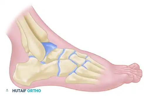 TALONAVICULAR JOINT ARTHRODESIS Surgical Diagram