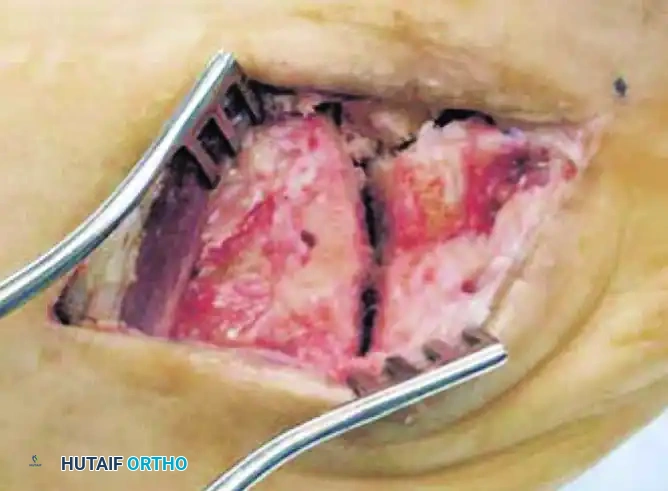 TARSOMETATARSAL INTERPOSITIONAL ARTHROPLASTY Surgical Diagram