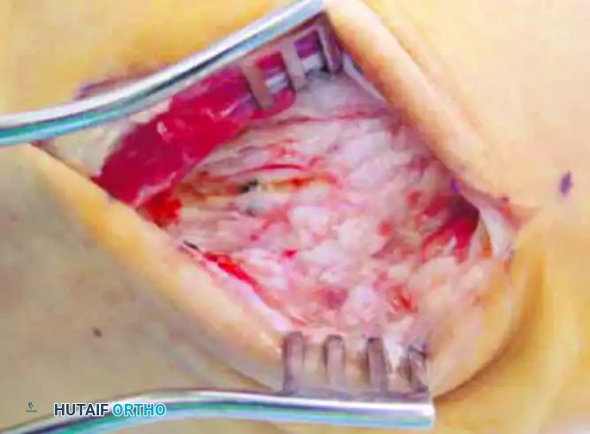 TARSOMETATARSAL INTERPOSITIONAL ARTHROPLASTY Surgical Diagram