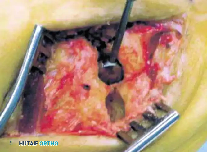 TARSOMETATARSAL INTERPOSITIONAL ARTHROPLASTY Surgical Diagram