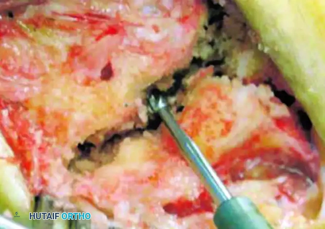 TARSOMETATARSAL INTERPOSITIONAL ARTHROPLASTY Surgical Diagram