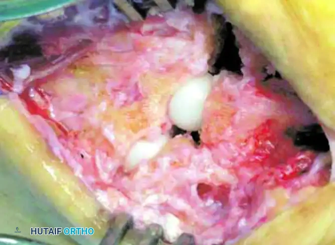 TARSOMETATARSAL INTERPOSITIONAL ARTHROPLASTY Surgical Diagram