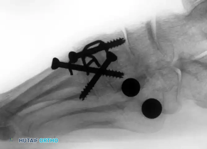 TARSOMETATARSAL INTERPOSITIONAL ARTHROPLASTY Surgical Diagram