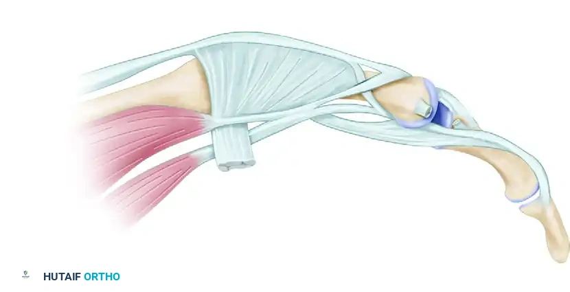 Mastering PIP Joint Collateral Ligament Reconstruction via Tendon Graft