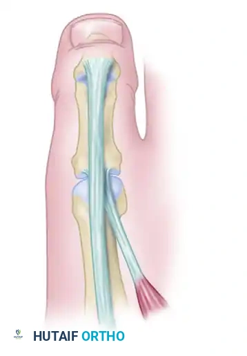 TENDON SUSPENSION OF THE FIRST METATARSAL AND INTERPHALANGEAL JOINT ARTHRODESIS Surgical Diagram