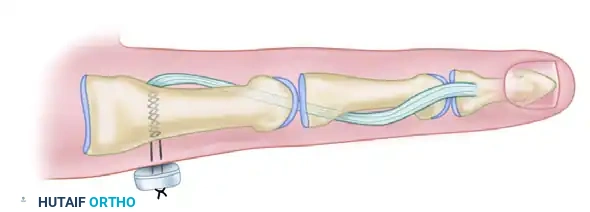 Tendon Transfer for Chronic Mallet Finger and Extensor Mechanism Reconstruction