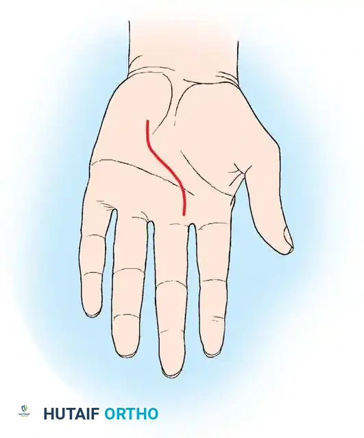Extended longitudinal palmar incision