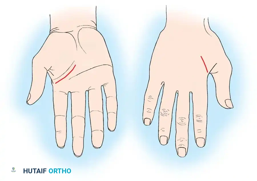 Thenar crease and dorsal longitudinal incisions