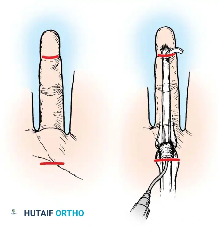 Closed irrigation for tenosynovitis (modified Neviaser technique)