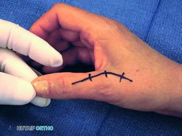 Tension Band Arthrodesis of the Thumb Metacarpophalangeal Joint: A Comprehensive Surgical Guide