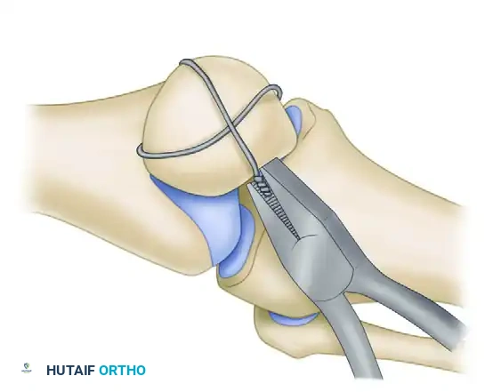 FIGURE 54-63 A-C, Schauwecker method of com­ pression wiring of patella using supplemental screws for comminuted fracture (C) . Comminuted fragments (A) are transformed with screws into bifragmental fracture (B) . SEE TECHNIQUE 54-21.