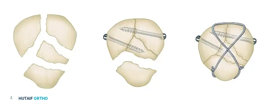 TENSION BAND WIRING FIXATION Surgical Diagram