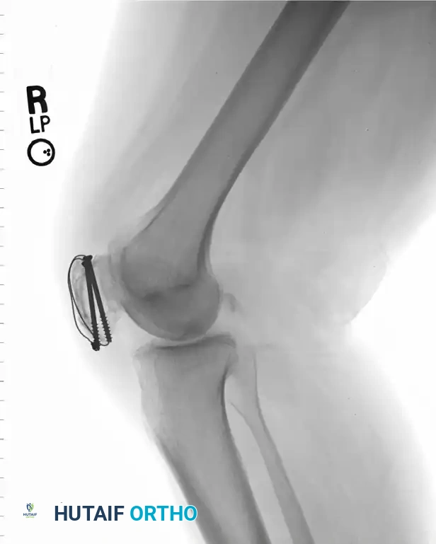 TENSION BAND WIRING FIXATION Surgical Diagram