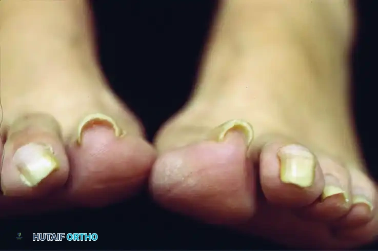 TERMINAL SYME PROCEDURE Surgical Diagram