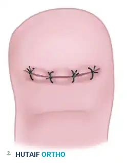 TERMINAL SYME PROCEDURE Surgical Diagram