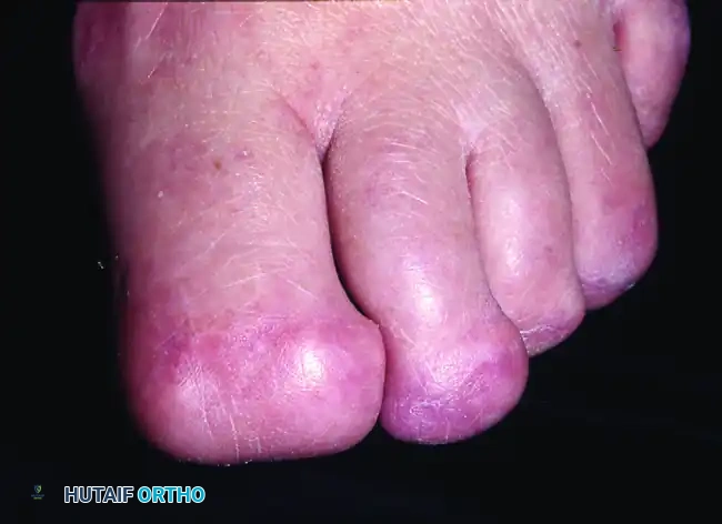 TERMINAL SYME PROCEDURE Surgical Diagram