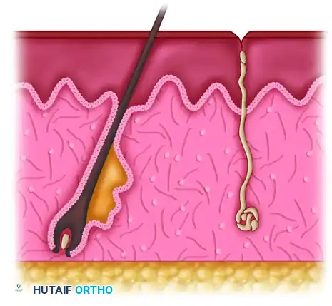 Operative Management of Thermal Hand Burns