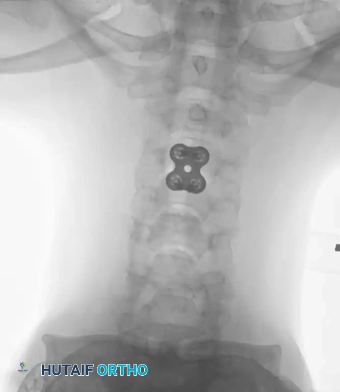 Anterior Plating Diagram D