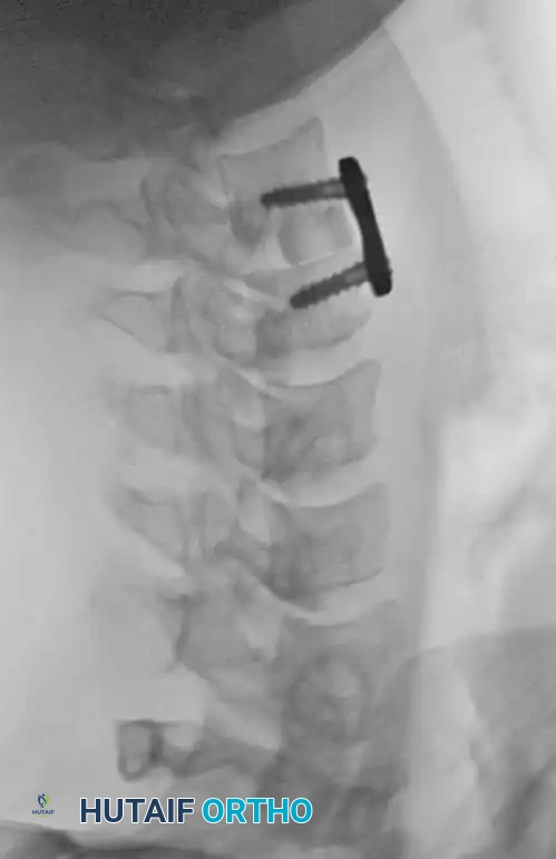 Anterior Plating Diagram C