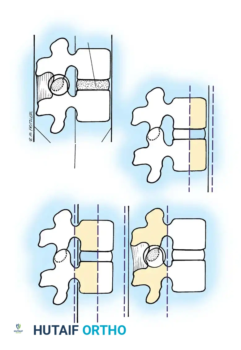 Mastering the Management of Thoracic and Lumbosacral Fractures