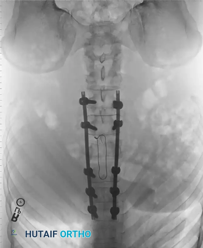 Intraoperative Fluoroscopy 2