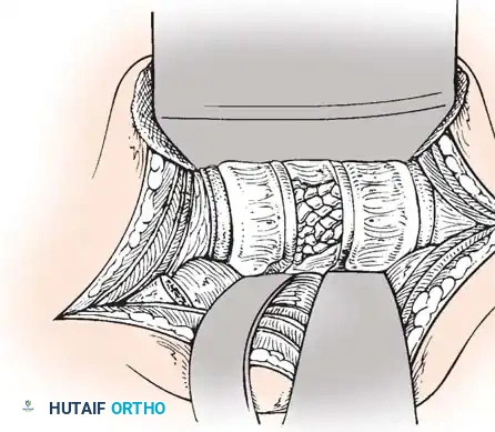 Pedicle Screw Diagram 5