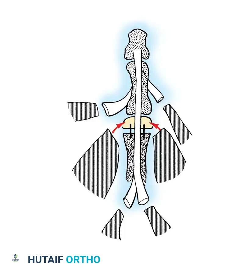 Masterclass in Thumb and Finger Reconstruction: Toe-to-Hand Transfer
