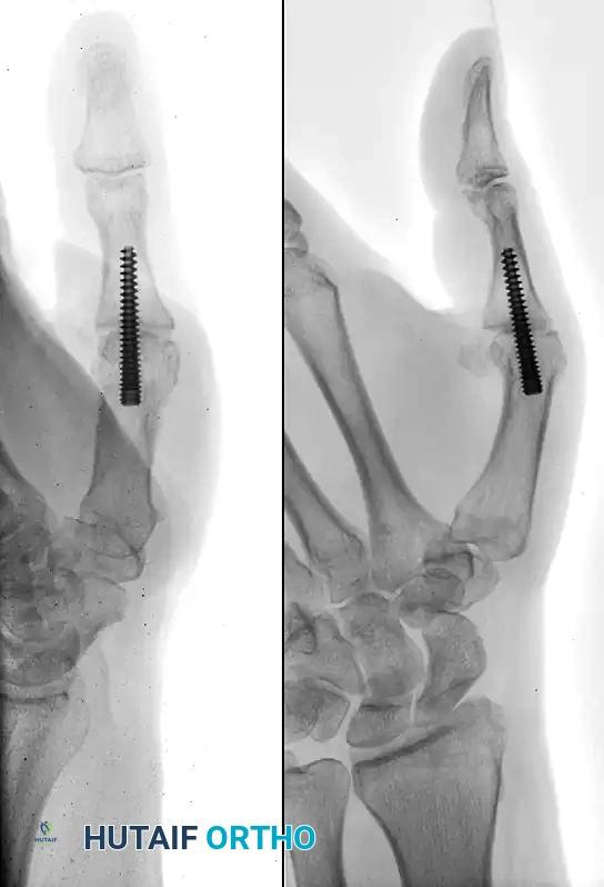 Mastering Thumb Metacarpophalangeal and Trapeziometacarpal Joint Arthrodesis