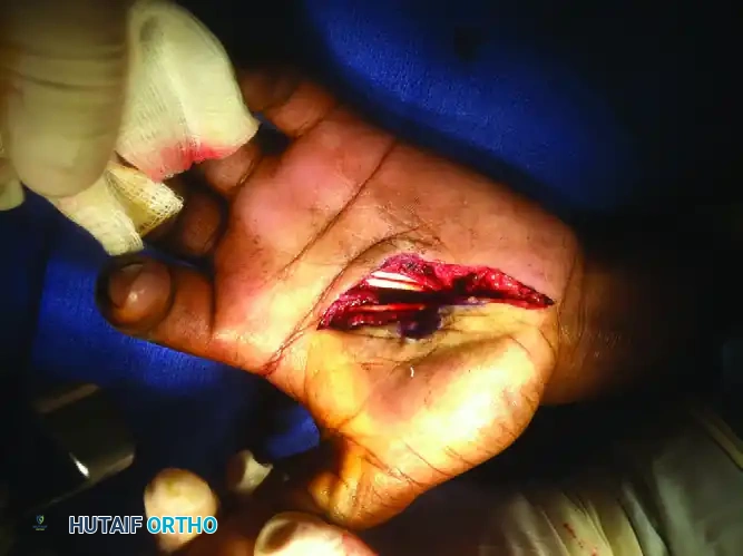 Operative Management of Bennett Fractures and Thumb CMC Joint Trauma