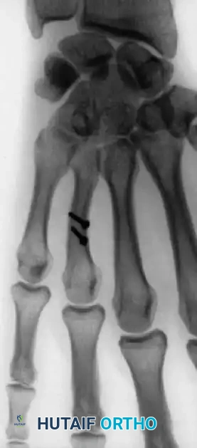 Operative Management of Thumb Carpometacarpal Fractures