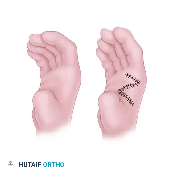 Surgical Management of Thumb Hypoplasia, Adduction Contractures, and Disproportion