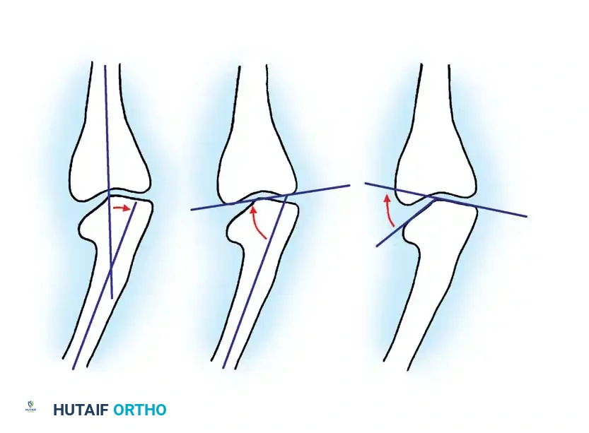 Comprehensive Management of Tibia Vara (Blount Disease)
