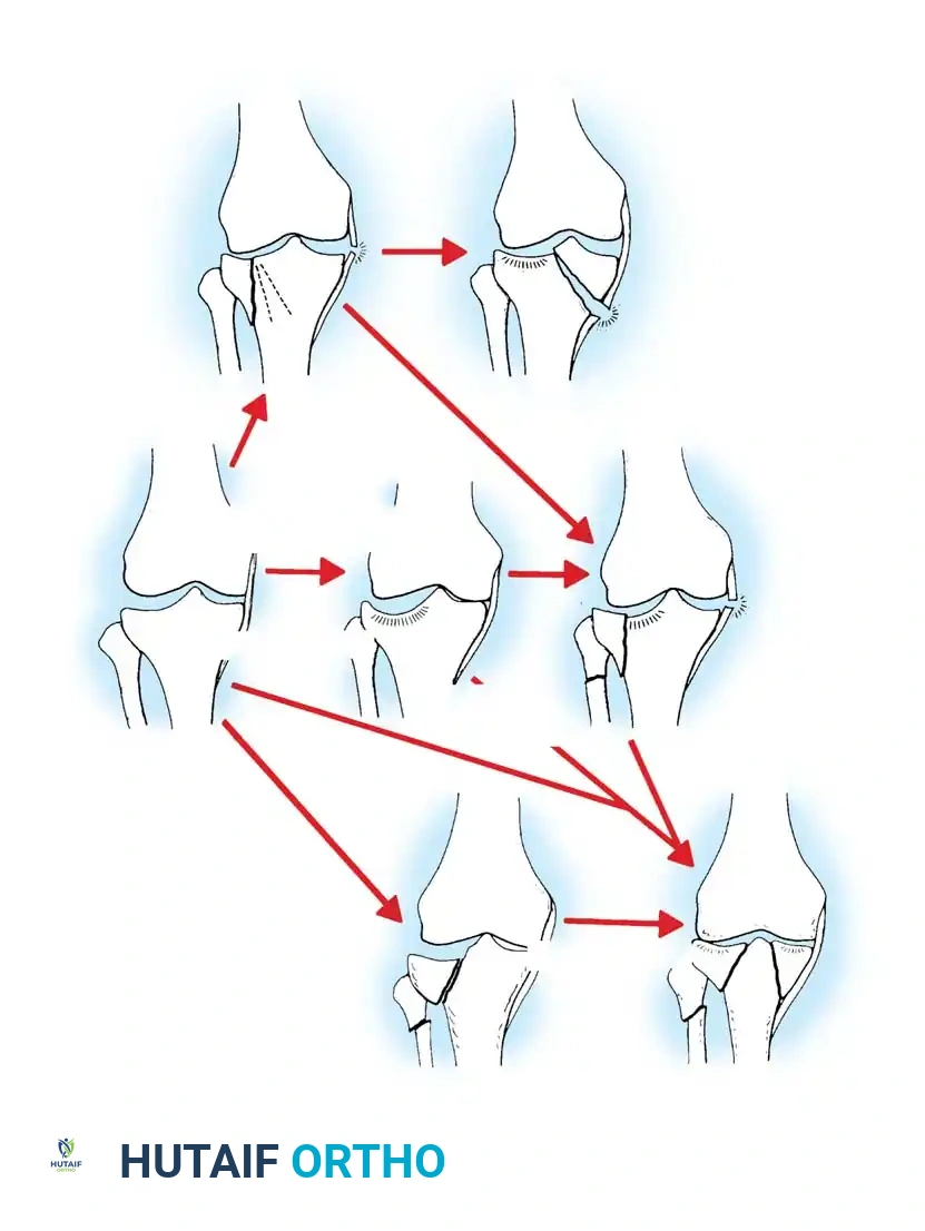 Illustration of plateau fracture tibial - Dr. Mohammed Hutaif