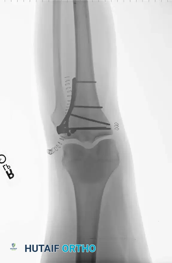 تفاصيل إضافية لكسور هضبة الساق