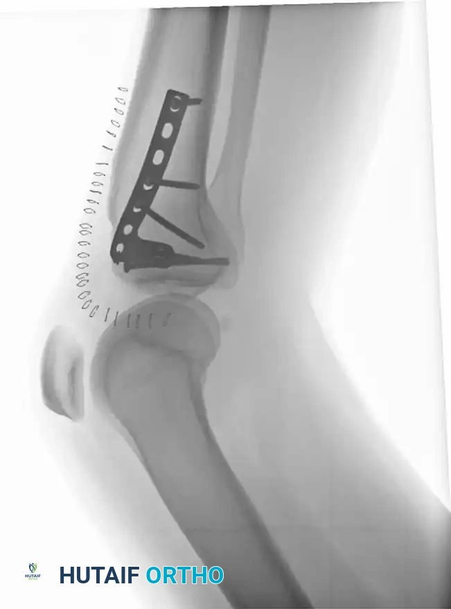 تأثير الكسور على أربطة الركبة