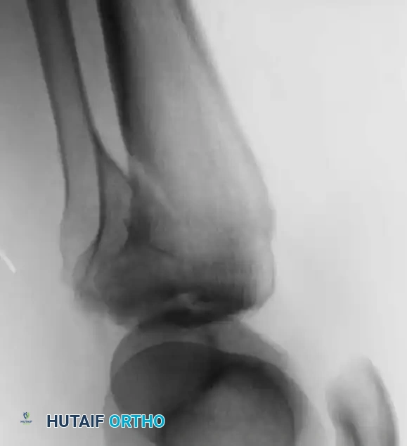 التصوير الإشعاعي أثناء الجراحة للتأكد من التثبيت