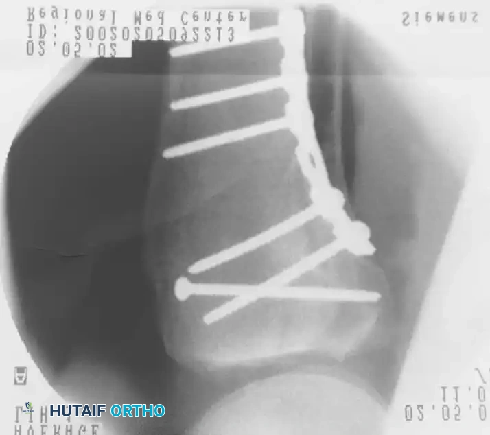 استخدام شريحتين لتثبيت الكسور المعقدة