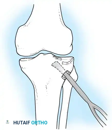 رفع سطح المفصل المكسور أثناء الجراحة