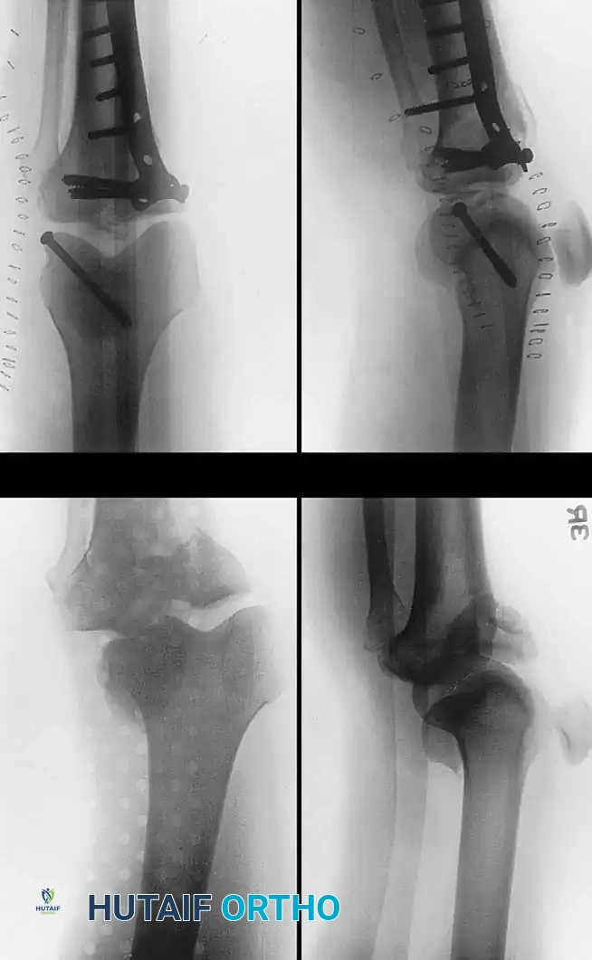 النهج الجراحي للوصول إلى مفصل الركبة