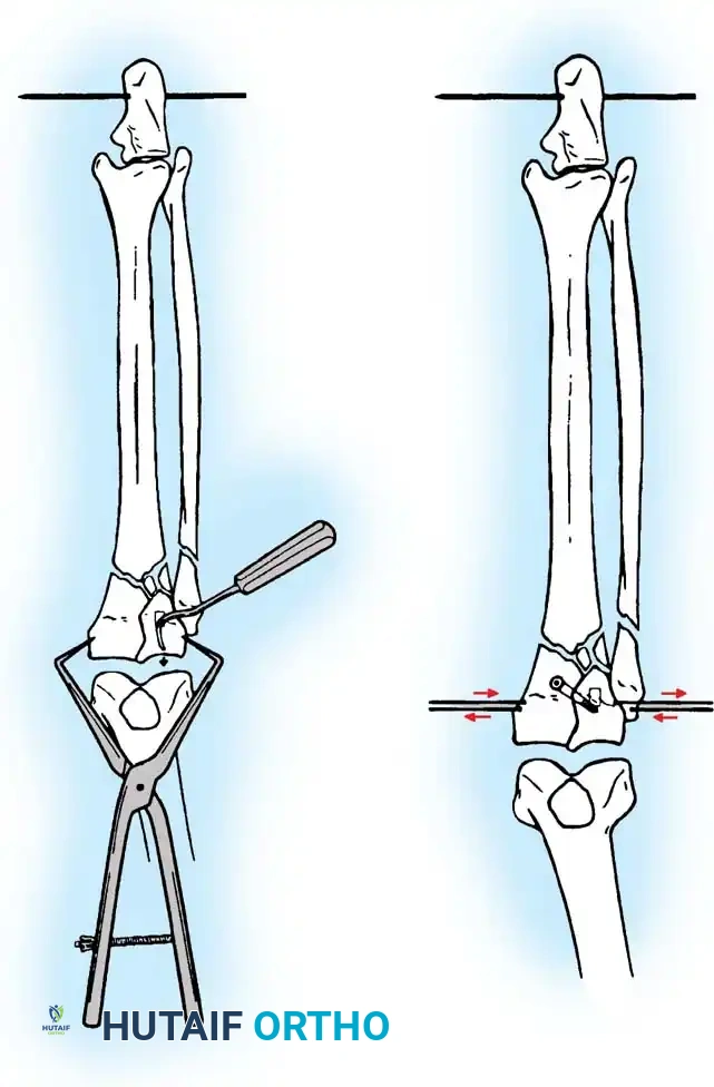مراحل متقدمة من التئام كسر هضبة التيبيا