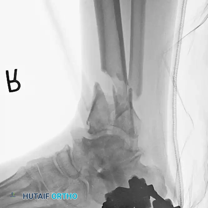 TIBIAL SHAFT Surgical Diagram