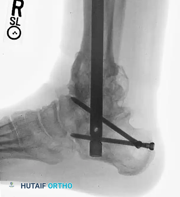 TIBIAL SHAFT Surgical Diagram