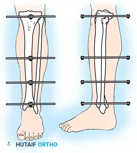 Hutaifortho's Orthopaedic Diagram