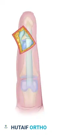 TIMING OF FLEXOR TENDON REPAIR Surgical Diagram