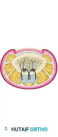 TIMING OF FLEXOR TENDON REPAIR Surgical Diagram