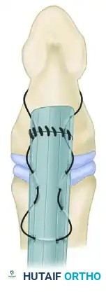 Fig. 66-29 ). If several tendon ends are to be fixed to bone, they are best inserted into a large hole drilled in the bone.
